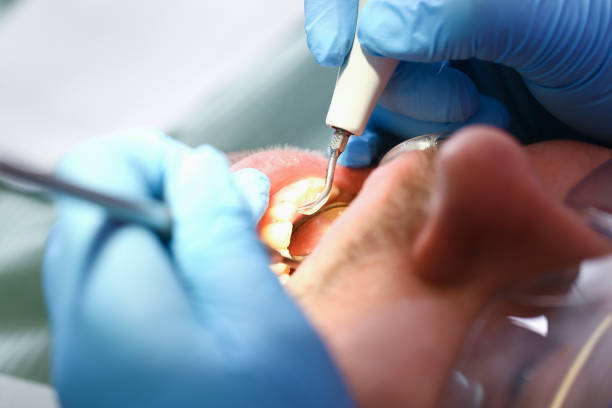 Best Emergency Wisdom Tooth Extraction in Nd Lake, WI